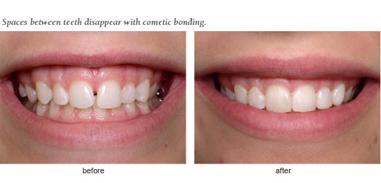 Dental Bonding Video  Tooth Bonding 